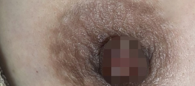 Level 1 - 乳輪まわり施術前