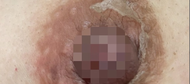 Level 2 - 乳輪まわり3〜7日後
